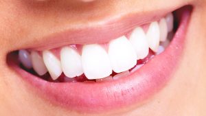 simle-access-blanchiment-dentaire-3-300x169