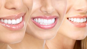 simle-access-blanchiment-dentaire-300x169